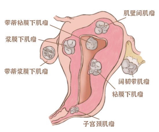 子宫肌瘤与怀孕，一场需要理解的双行之旅